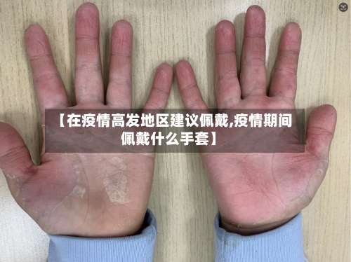 【在疫情高发地区建议佩戴,疫情期间佩戴什么手套】-第3张图片